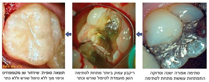 ריקבון עמוק, קומפוזיט וכיפוי מוך, ללא טיפול שורש וללא כתר