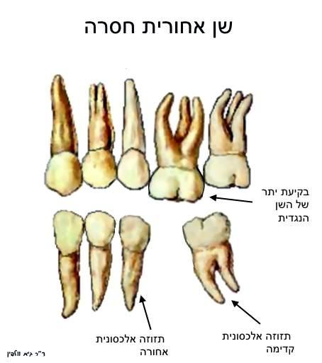 תזוזות שיניים - שן אחורית נעקרה